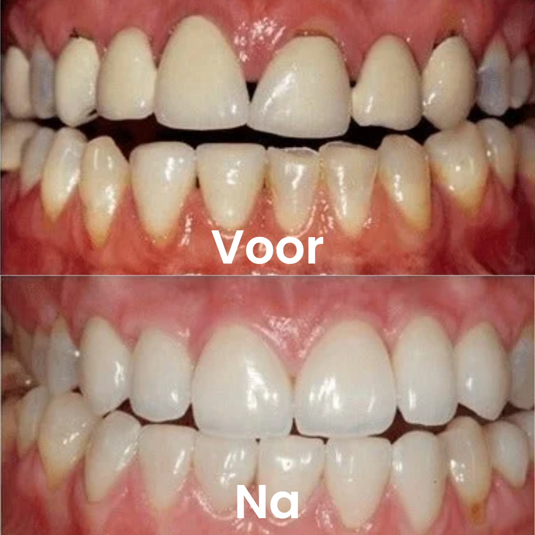 Tandvlees Reparatiegel